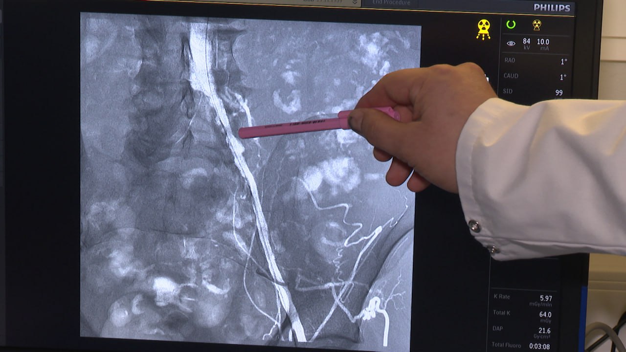 Пациентов с критической ишемией ног смогут спасти от ампутации в Волгограде Пациентов с критической ишемией ног смогут спасти от ампутации в Волгограде