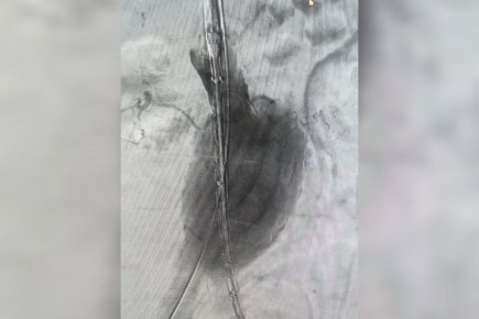 В Волгоградской областной больнице №1 провели уникальную операцию по установке стент-графта для лечения аневризмы брюшной аорты