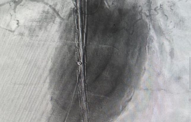 В Волгоградской облбольнице № 1 пожилому пациенту с крупной аневризмой брюшной артерии выполнили уникальную операцию