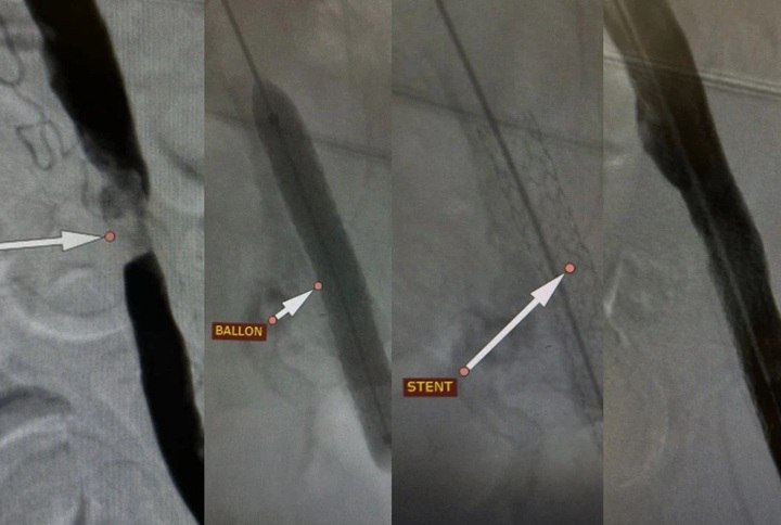 Ушел из больницы на своих ногах, хотя грозила ампутация: волгоградские врачи совершили чудо