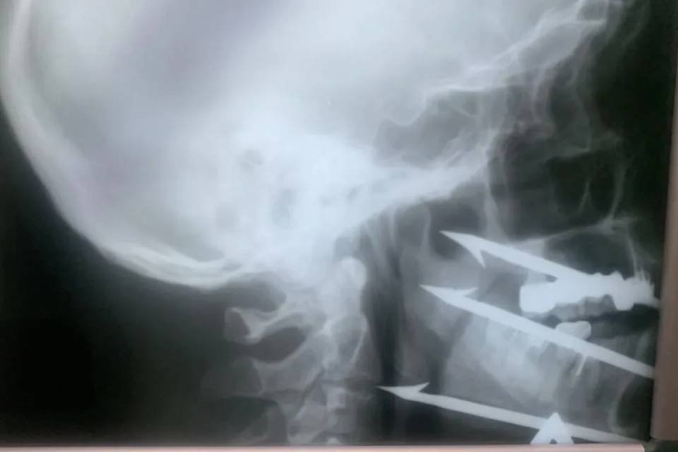 Волгоградские врачи спасли рыбака с гарпуном в лице