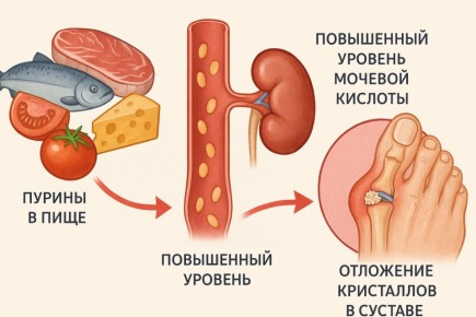 Подагра: советы по питанию для снижения уровня мочевой кислоты