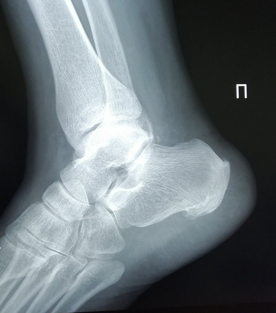 Как победить плантарный фасциит: практические советы и эффективные средства