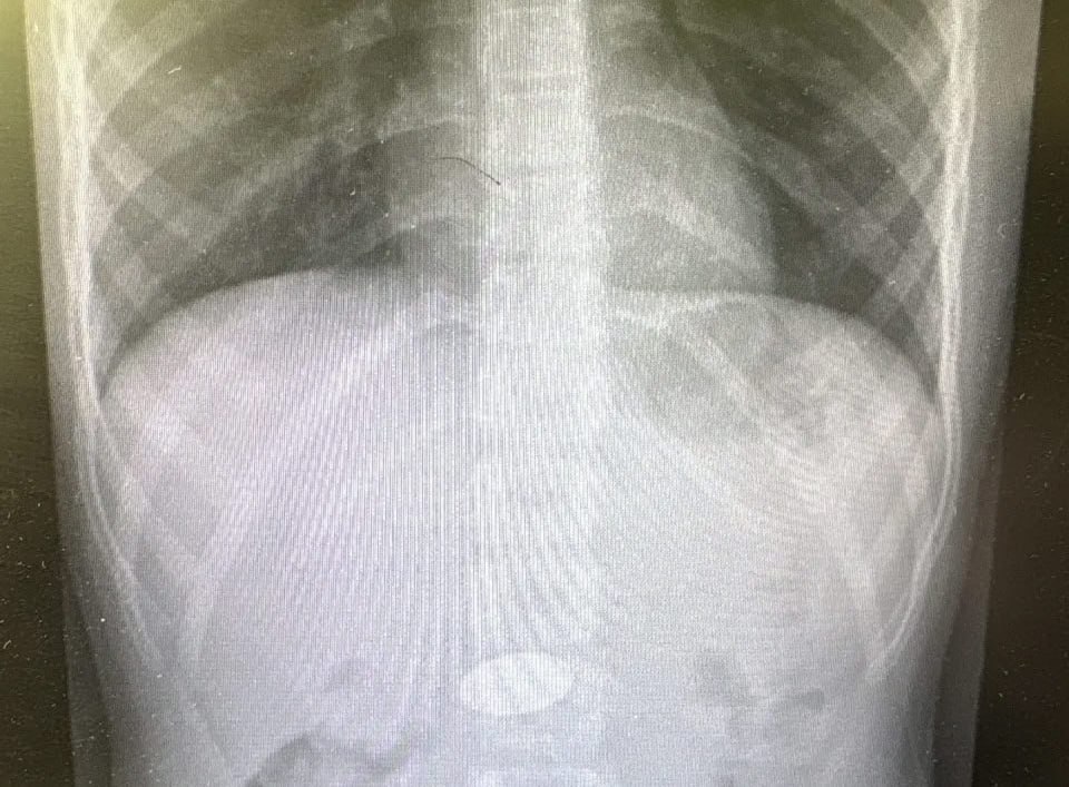 В Волгограде спасли мальчика, проглотившего пятирублевую монету