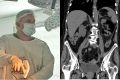 Удалили почку без единого разреза: волгоградские врачи спасли пациентку с опасным недугом